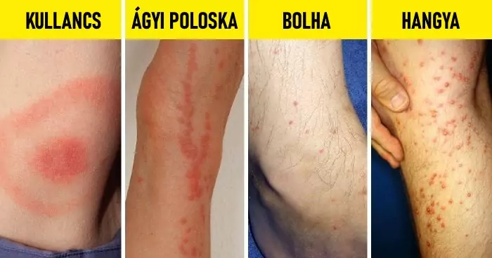 Rovarcsípés
